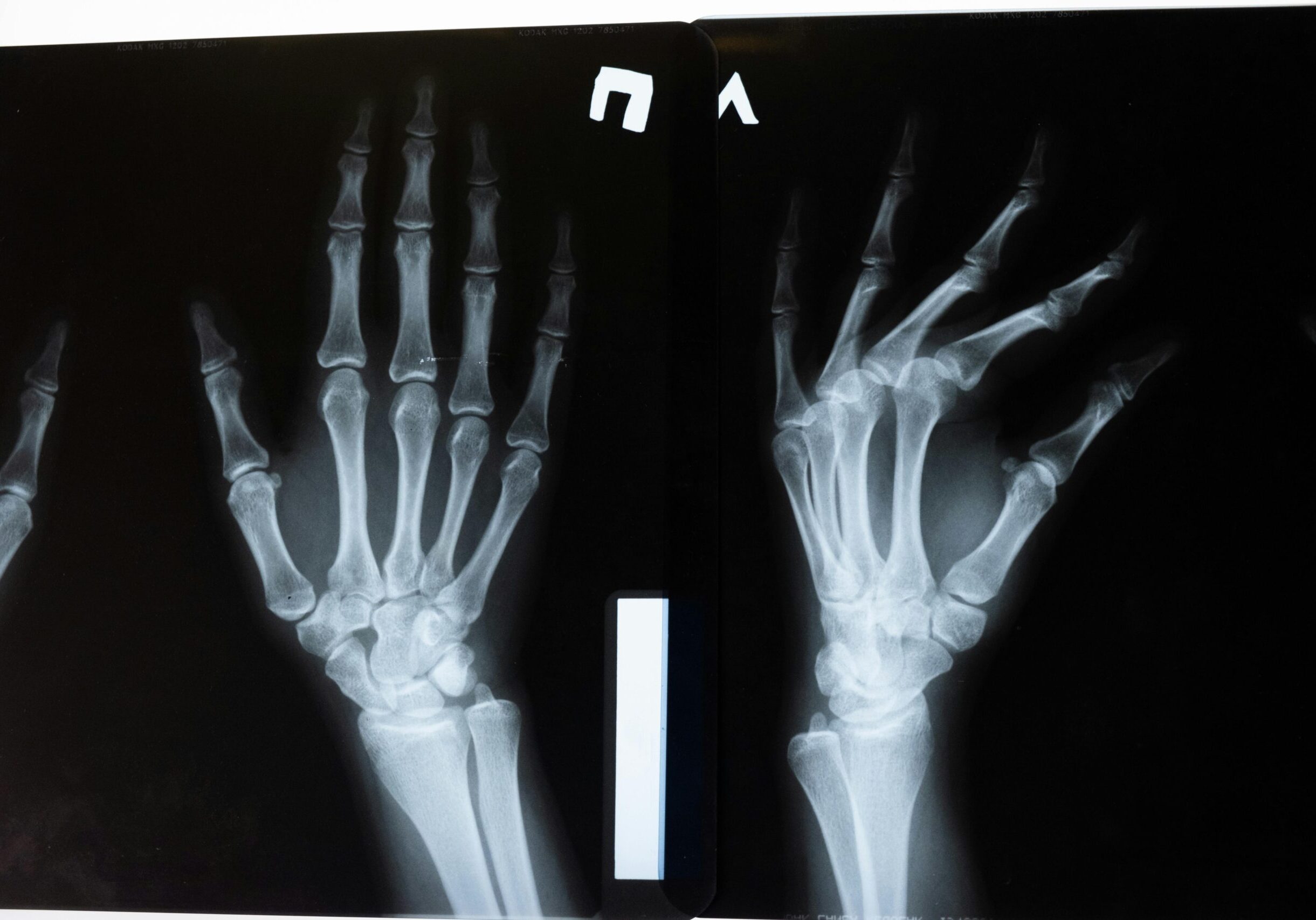 High-resolution x-ray image showing the intricate anatomy of human hands.